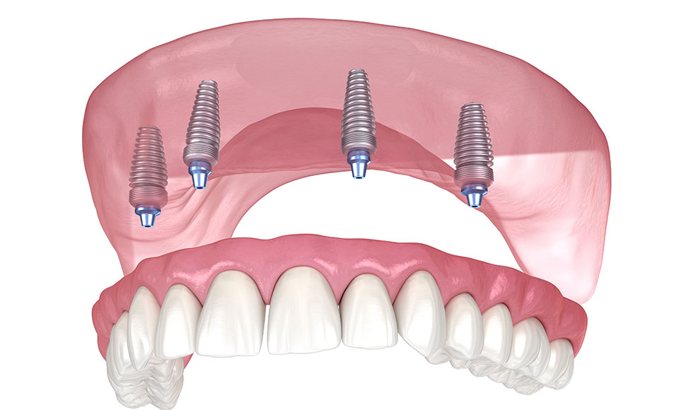 All-on-4（オールオンフォー）×インプラントオーバーデンチャー